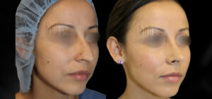 Rhinoplasty Patient 48 Before & After - Thumbnail