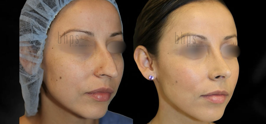 Rhinoplasty Patient 48 Before & After