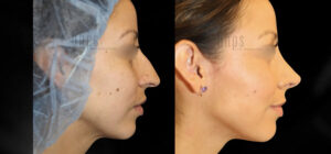 Rhinoplasty Patient 48 Before & After - Thumbnail