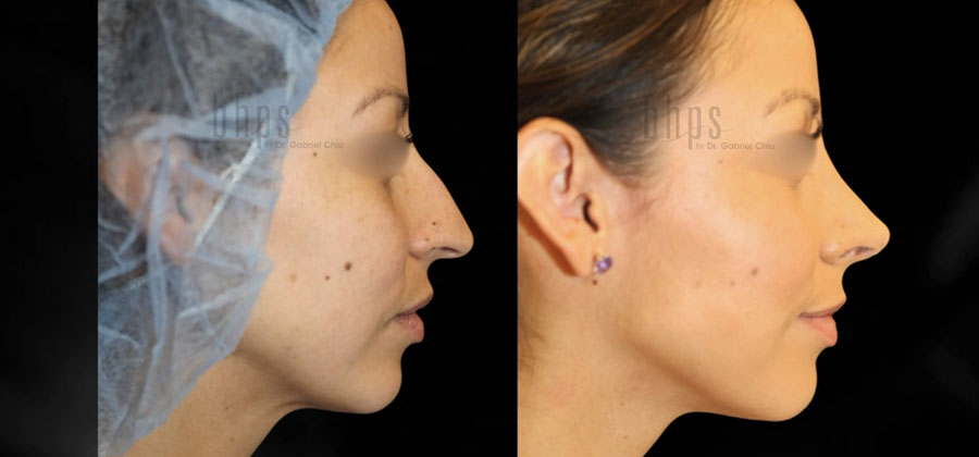 Rhinoplasty Patient 48 Before & After