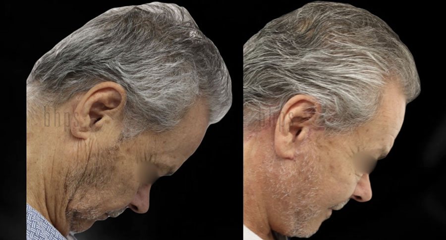 Face Lift Patient 02 Before & After