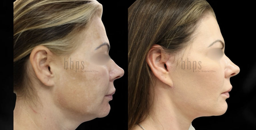 Face Lift Patient 03 Before & After