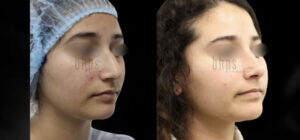 Rhinoplasty Patient 49 Before & After - Thumbnail