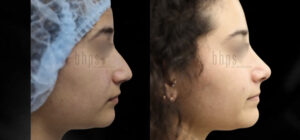 Rhinoplasty Patient 49 Before & After - Thumbnail