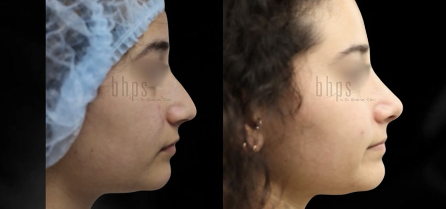 Rhinoplasty Patient 49 Before & After