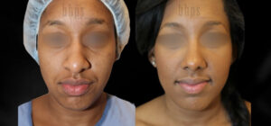 Rhinoplasty Patient 50 Before & After - Thumbnail