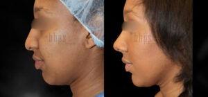 Rhinoplasty Patient 50 Before & After - Thumbnail