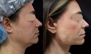 Chin Implants Patient 02 Before & After - Thumbnail