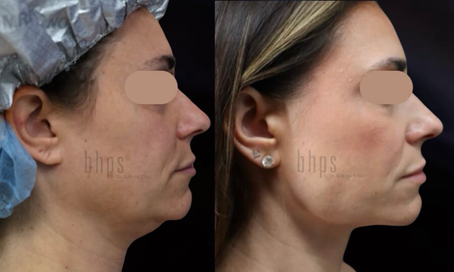 Chin Implants Patient 02 Before & After