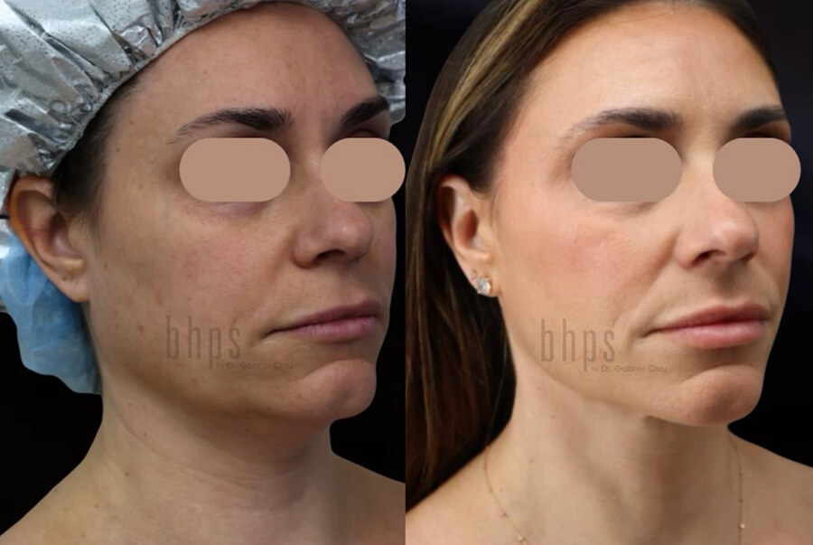 Chin Implants Patient 02 Before & After