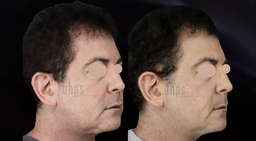 Non-Surgical Patient 02 Before & After