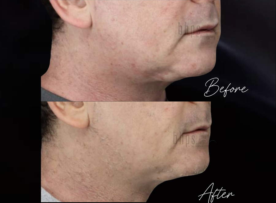 Non-Surgical Patient 02 Before & After