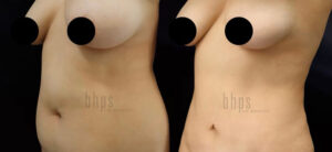 Tummy Tuck Patient 27 Before & After - Thumbnail