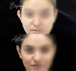 Otoplasty Patient 08 Before & After - Thumbnail