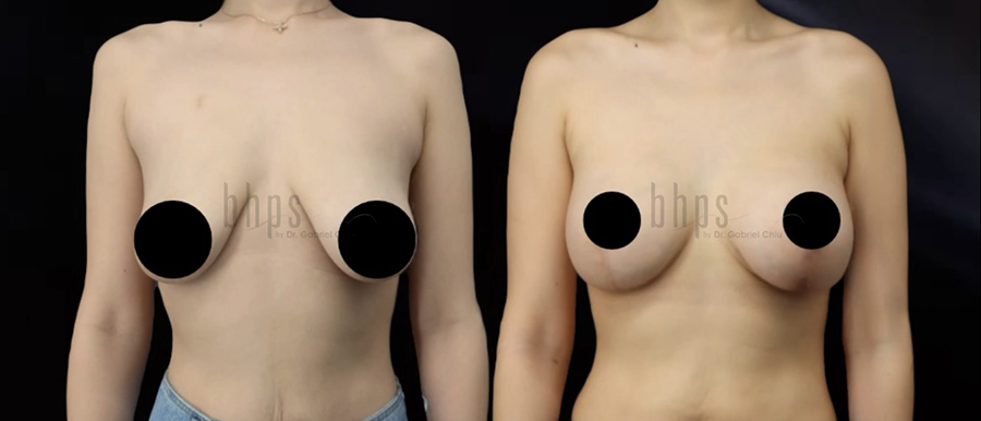 Breast Lift Patient 12 Before & After