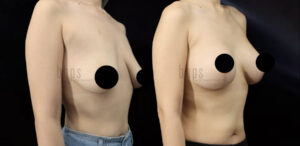 Breast Lift Patient 12 Before & After - Thumbnail