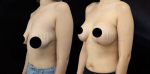 Breast Lift Patient 12 Before & After - Thumbnail