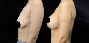 Breast Lift Patient 12 Before & After - Thumbnail