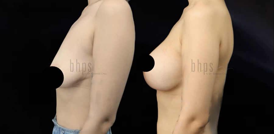 Breast Lift Patient 12 Before & After