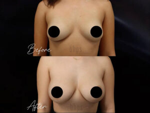 Breast Augmentation Patient 103 Before & After - Thumbnail