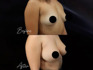 Breast Augmentation Patient 103 Before & After - Thumbnail