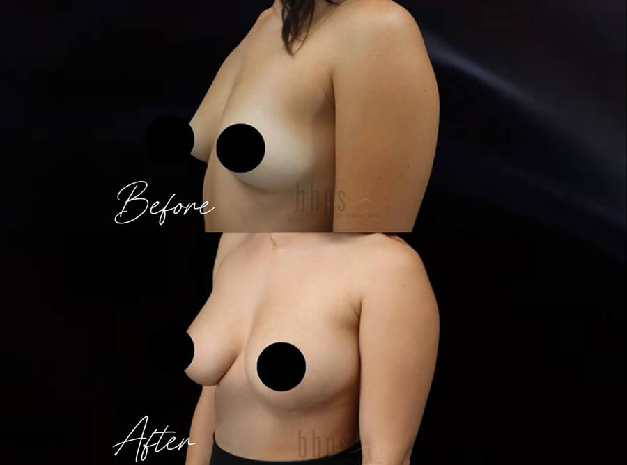 Breast Augmentation Patient 103 Before & After