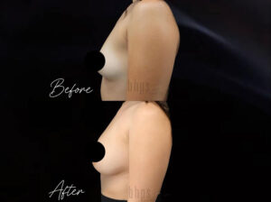 Breast Augmentation Patient 103 Before & After - Thumbnail