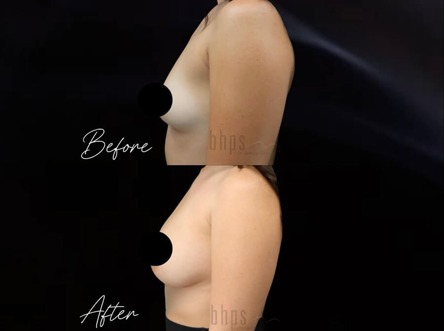 Breast Augmentation Patient 103 Before & After