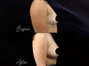 Breast Augmentation Patient 103 Before & After - Thumbnail