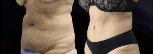 Tummy Tuck Patient 28 Before & After - Thumbnail