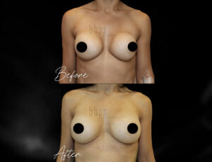 Cosmetic Breast Reconstruction Patient 04 Before & After - Thumbnail