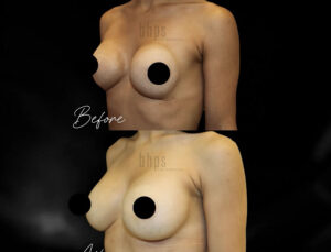 Cosmetic Breast Reconstruction Patient 04 Before & After - Thumbnail