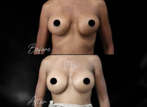 Breast Implant Removal Patient 02 Before & After - Thumbnail