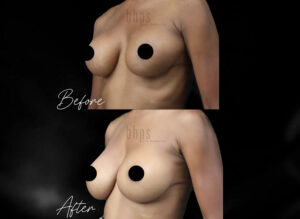 Breast Implant Removal Patient 02 Before & After - Thumbnail