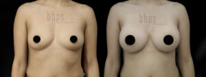 Breast Augmentation Patient 105 Before & After - Thumbnail