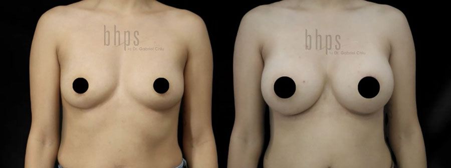 Breast Augmentation Patient 105 Before & After