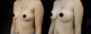 Breast Augmentation Patient 105 Before & After - Thumbnail