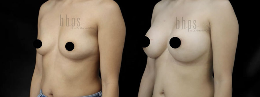 Breast Augmentation Patient 105 Before & After