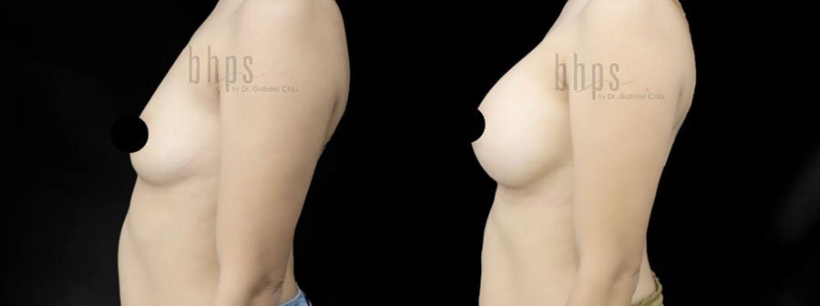 Breast Augmentation Patient 105 Before & After