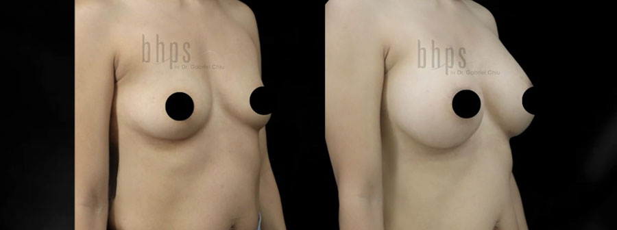 Breast Augmentation Patient 105 Before & After