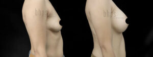 Breast Augmentation Patient 105 Before & After - Thumbnail