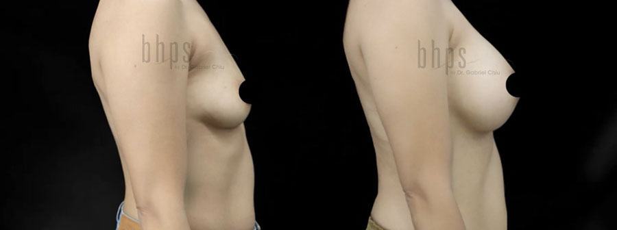 Breast Augmentation Patient 105 Before & After