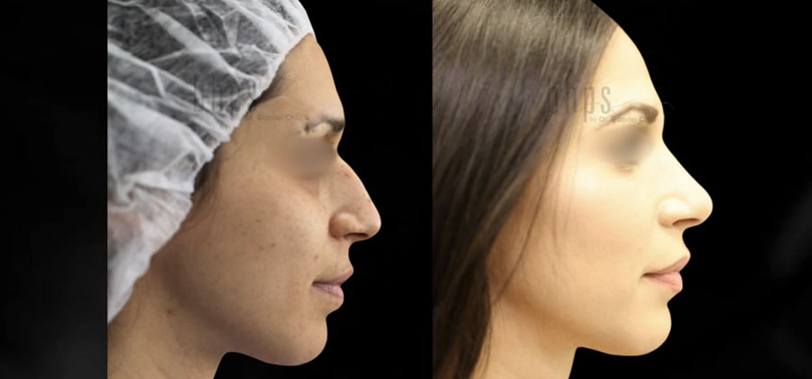 Rhinoplasty Patient 54 Before & After