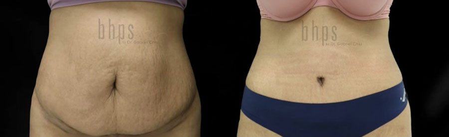 Tummy Tuck Patient 33 Before & After