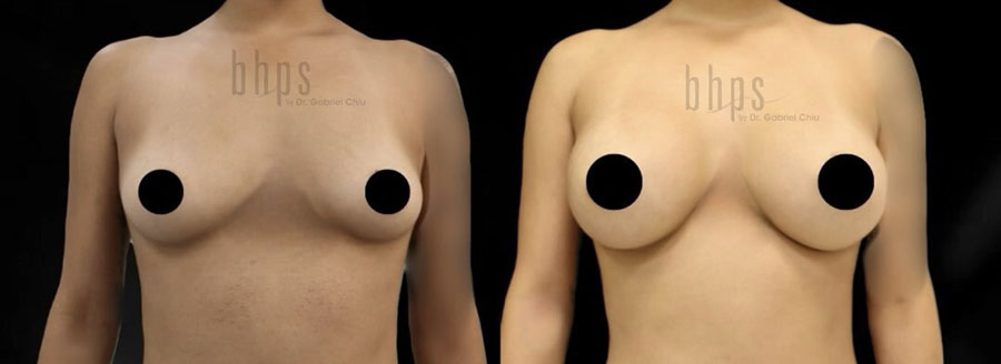 Breast Augmentation Patient 106 Before & After