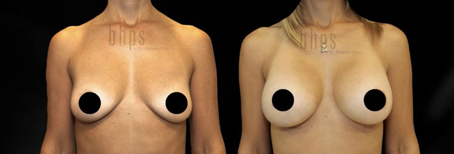 Breast Augmentation Patient 107 Before & After