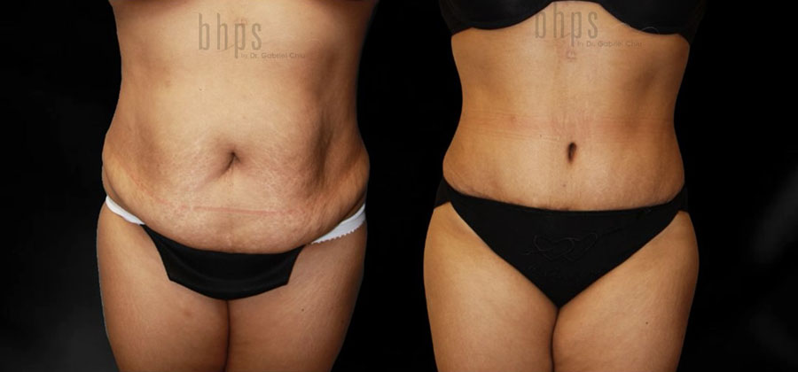 Tummy Tuck Patient 32 Before & After