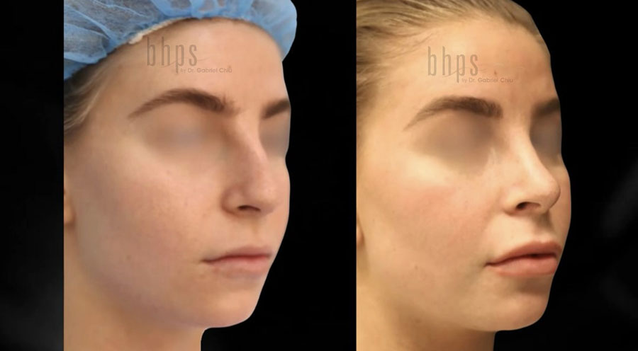 Rhinoplasty Patient 51 Before & After