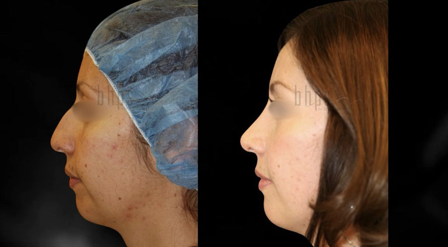 Rhinoplasty Patient 52 Before & After