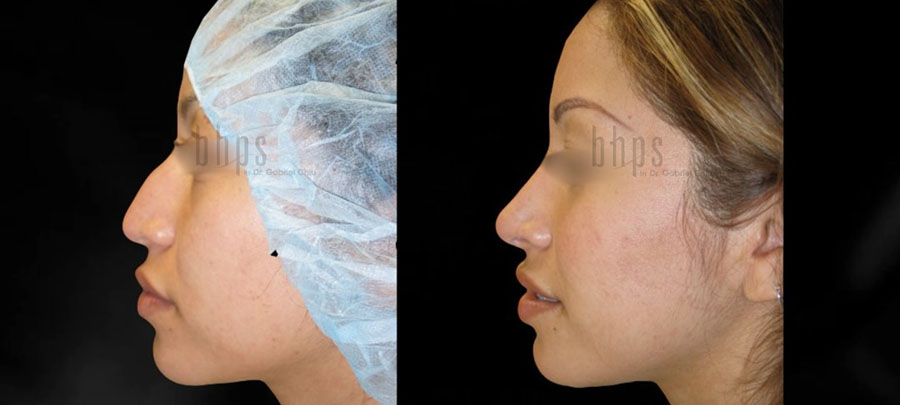 Rhinoplasty Patient 53 Before & After